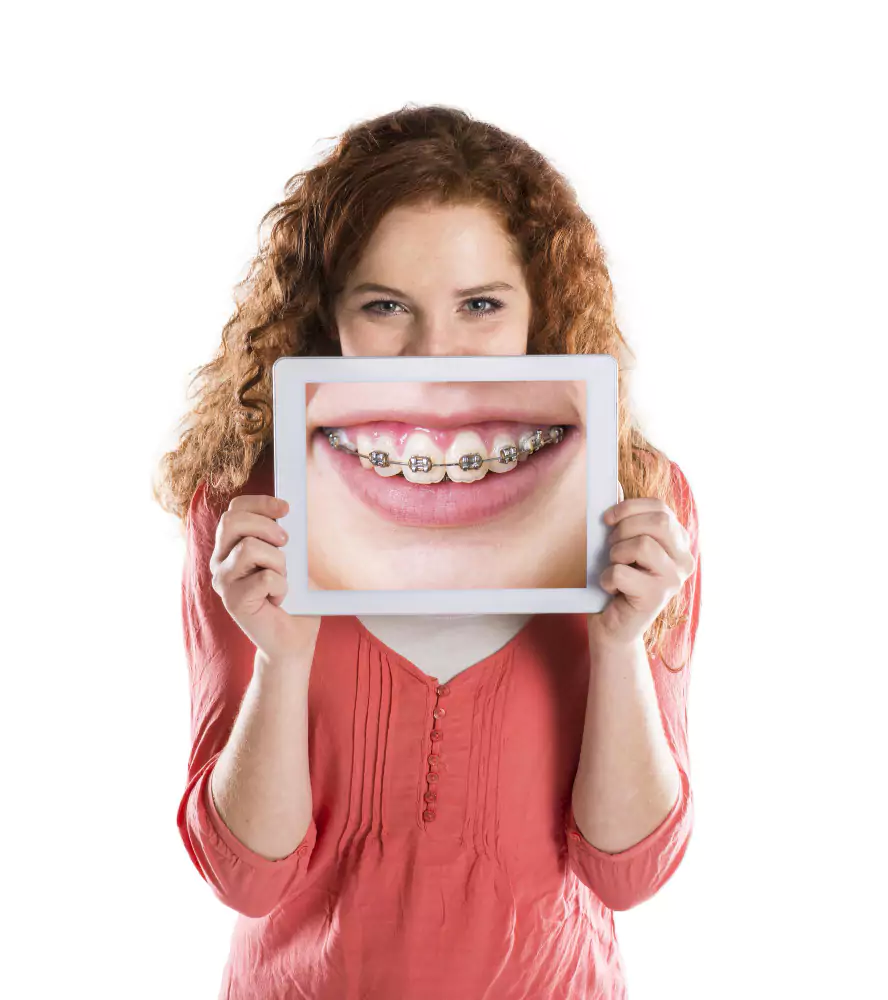 Dental Braces